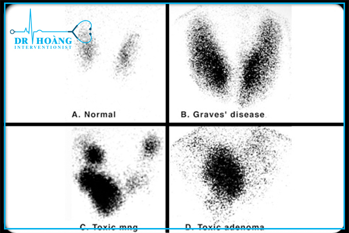 Xạ hình tuyến giáp: Phương pháp chẩn đoán hiệu quả và an toàn
