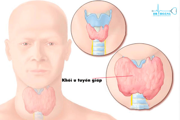 Đốt sóng cao tần có cần uống nhiều thuốc không? Đốt sóng cao tần có cần uống nhiều thuốc không?
