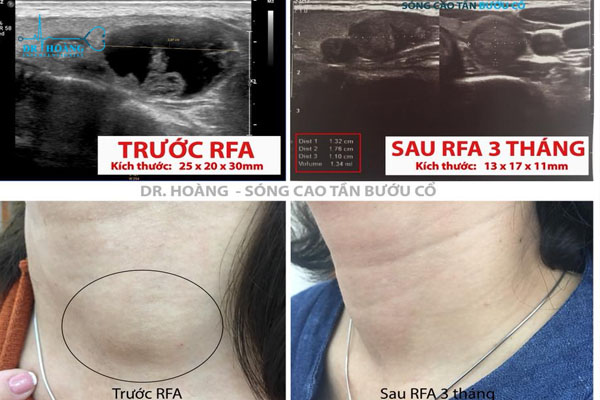 Đốt sóng cao tần điều trị u tuyến giáp không mổ, không đau