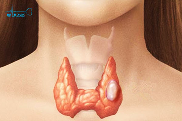 Bướu giáp nhân thùy trái có nguy hiểm không