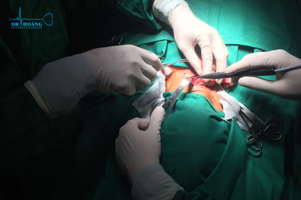 Điều trị u tuyến giáp và những quan điểm sai lầm