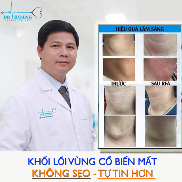 Đốt sóng cao tần điều trị u tuyến giáp có nhược điểm gì?