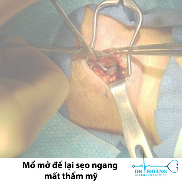Đốt sóng cao tần - Bước đột phá thẩm mỹ trong điều trị u tuyến giáp