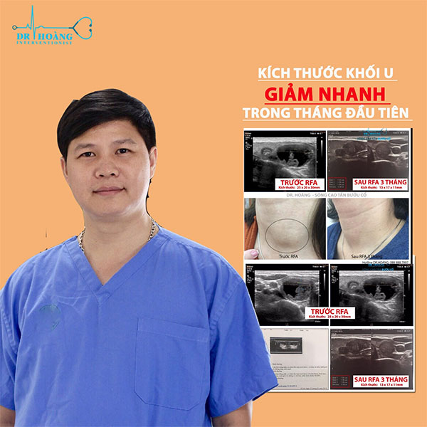 Đốt sóng cao tần u tuyến giáp: Thông tin cần nắm rõ