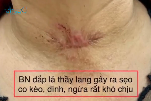 Đừng quá lo lắng khi bị u tuyến giáp!