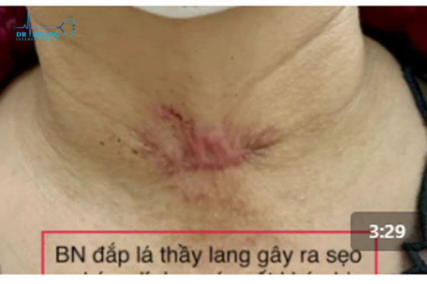 Hiểm họa từ những “thần dược”... chữa u tuyến giáp