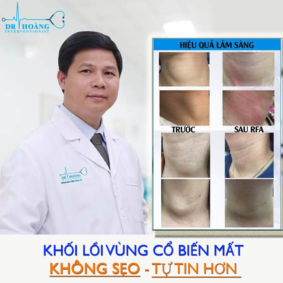 Không còn sợ sẹo khi điều trị u tuyến giáp lành tính