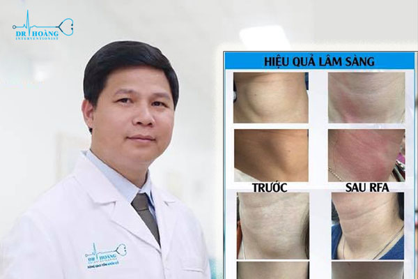 Nguy cơ biến chứng khi mổ u tuyến giáp