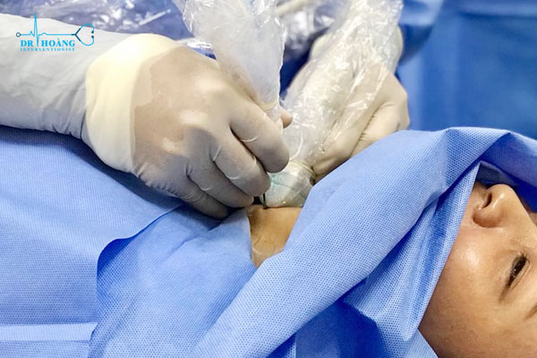 Nguyên lý cơ bản của đốt sóng cao tần u tuyến giáp