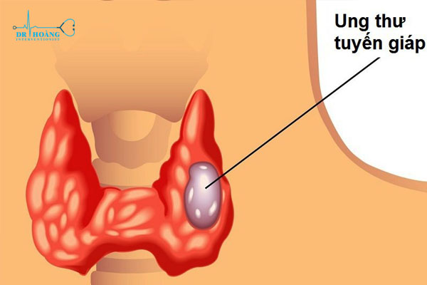 U tuyến giáp thể nhú và những thông tin cần biết