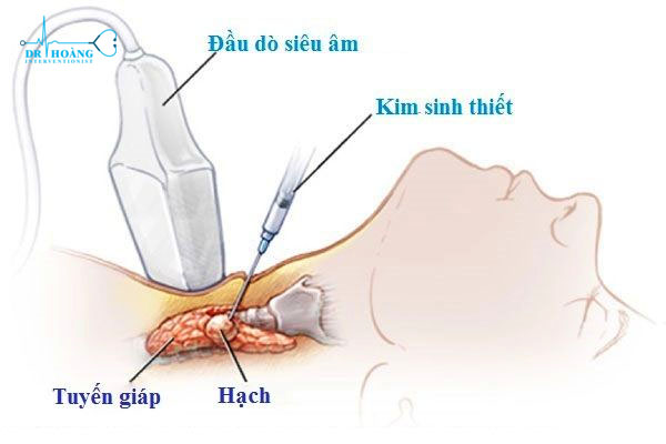 U tuyến giáp thể nhú và những thông tin cần biết
