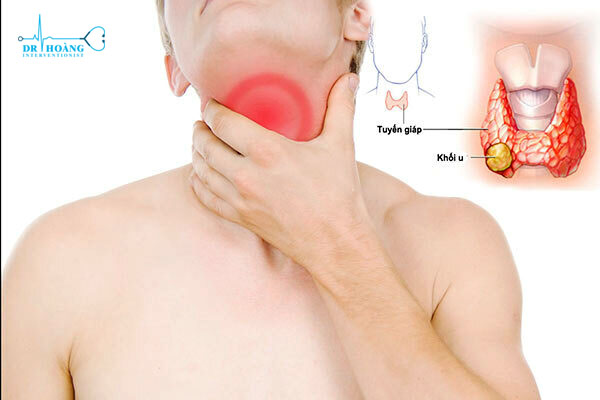 U tuyến giáp tự khỏi không