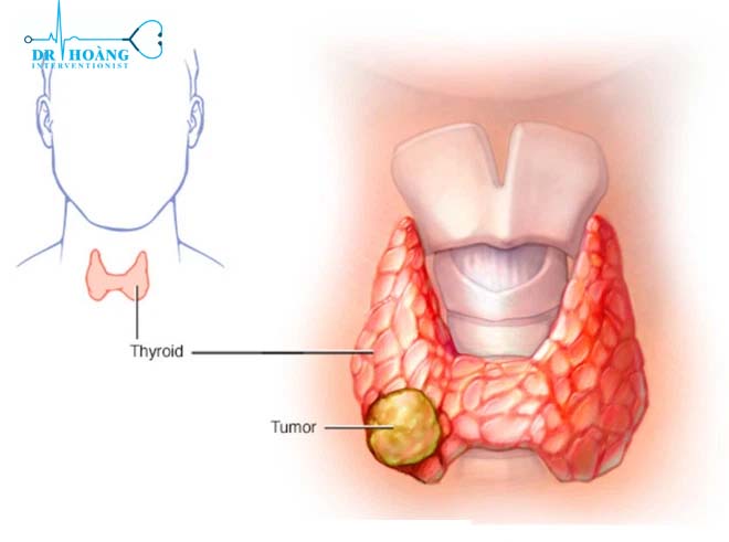 Làm sao cải thiện các dấu hiệu của u tuyến giáp?