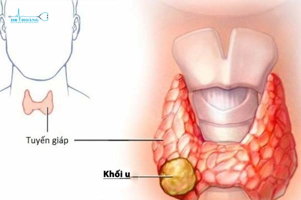 Nhân Thùy Phải Tuyến Giáp: Chẩn Đoán và Điều Trị Hiệu Quả