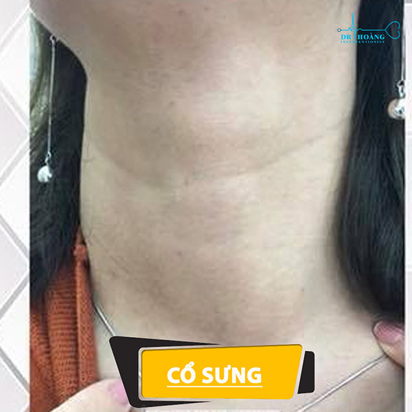 Cách loại bỏ u tuyến giáp: không nằm viện, tiết kiệm chi phí