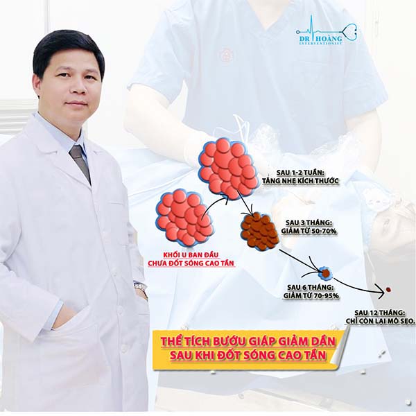 Đốt sóng cao tần u tuyến giáp có ưu điểm gì?