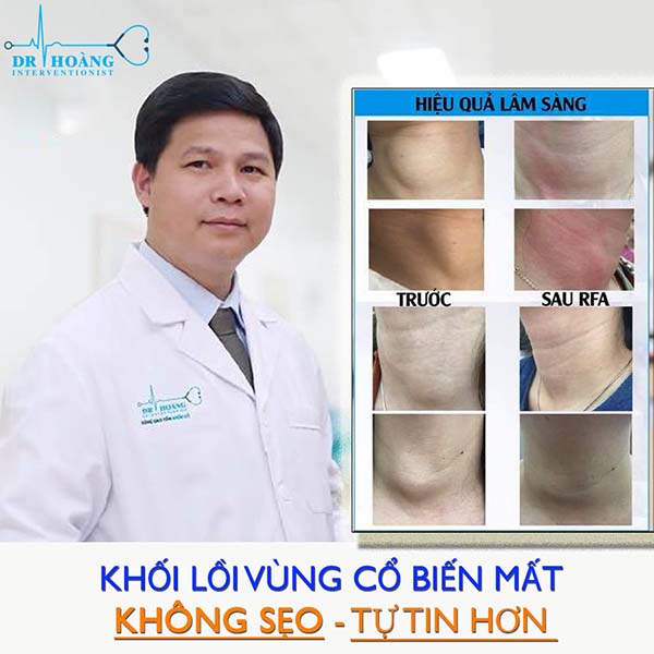 Đốt sóng cao tần nhân tuyến giáp an toàn, hiệu quả