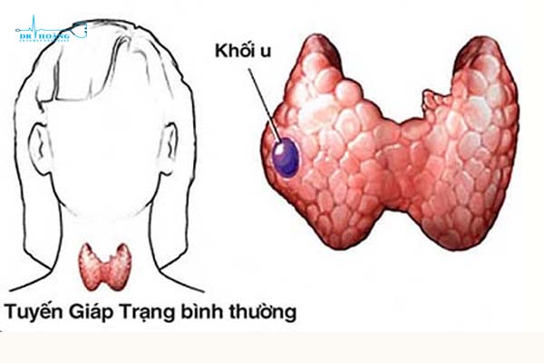Đốt sóng cao tần nhân tuyến giáp an toàn, hiệu quả