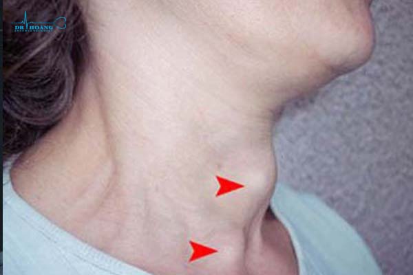 Khối u vùng cổ là dấu hiệu bệnh gì?