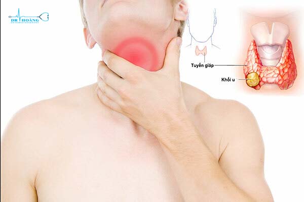 Khối u vùng cổ là dấu hiệu bệnh gì?