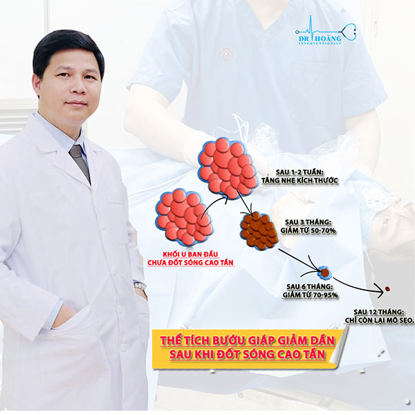 Cần đốt sóng cao tần u tuyến giáp mấy lần?