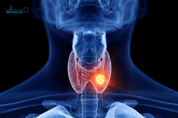 Phương pháp RFA điều trị u tuyến giáp có hiệu quả?