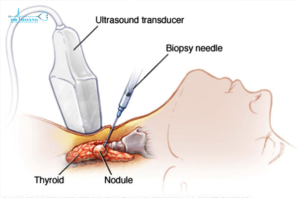 Phương pháp RFA điều trị u tuyến giáp có hiệu quả?