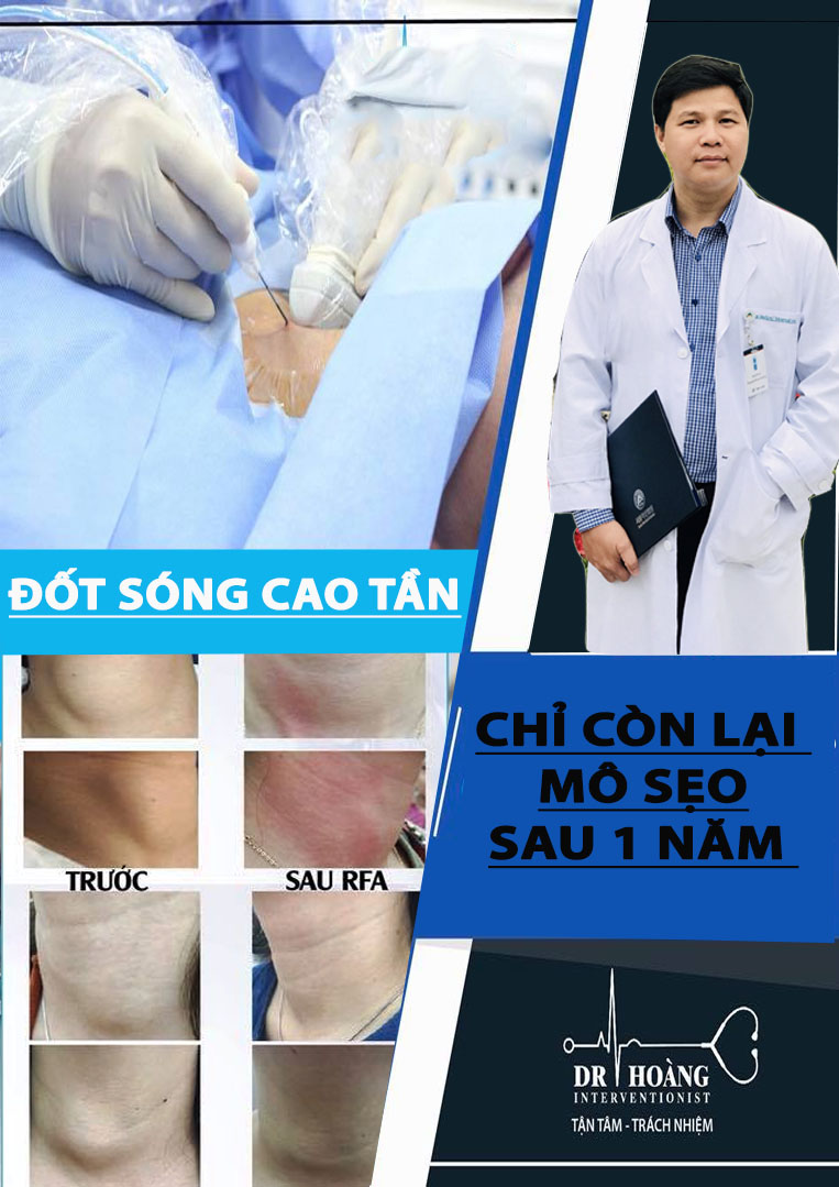 Tự chữa u tuyến giáp: Sai lầm dẫn đến hậu quả nghiêm trọng
