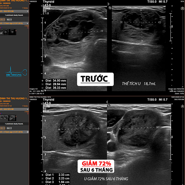 Chữa u tuyến giáp không cần mổ