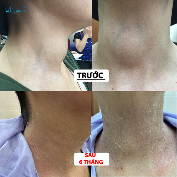Kết quả điều trị u tuyến giáp bằng đốt sóng cao tần sau 6 tháng