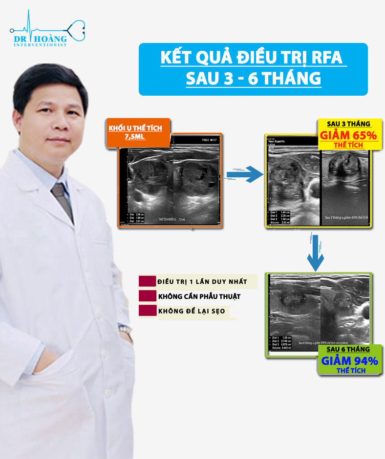 Địa chỉ tin cậy điều trị u tuyến giáp